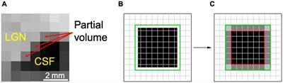 Improving the Quantification of the Lateral Geniculate Nucleus in Magnetic Resonance Imaging Using a Novel 3D-Edge Enhancement Technique